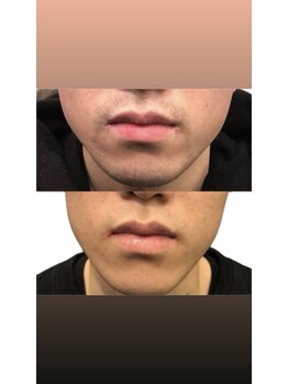 ハク(HAKU)/脱毛before→after