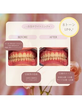 プラスビー 2号店(+b)/ホワイトニングビフォーアフター