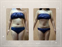 アバンダンティア 姫路店/脂肪冷却