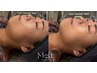【人気No.1＊】効果実感保証済み！医師監修×高出力サーマジェン通常￥13,800