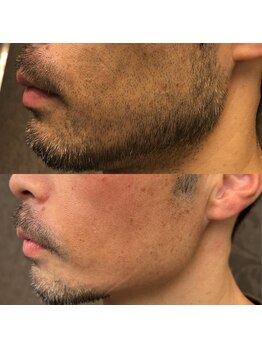 フェリーバ 流山店(FELIVA)/髭がなくなれば印象もUP!