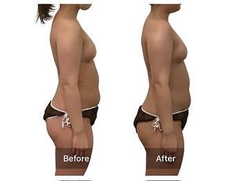 ベンザイ 新潟店(BENZAI)/痩身サロン？劇的サイズダウン