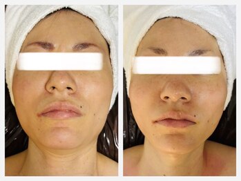 ペリドット(Peridot)/ほうれい線/エラ張り/歪み改善◎