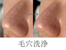 レイミー(reimee)/【毛穴洗浄】Before/After