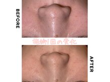 スローティラテ ヴィラボーテ(SLOWTEA RATTE Villa Beaute)の雰囲気（本場韓国の施術方法でしっかり毛穴ケア）