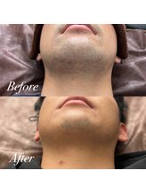 メンズ脱毛サロン ボス(BOSS)/お肌のお悩みはヒゲ脱毛で解決！