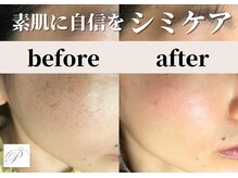 パールホワイトニング/ホワイトニングケアシミケア