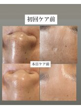 フットミー(foot mii)/肌質改善