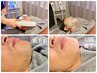 【男性脱毛】青ヒゲ&肌荒れ解消,美肌へ♪ヒゲ全体脱毛+ビタミンC誘導体パック