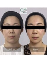 キュープ 下関店(Qpu)/美顔器コース4回での変化