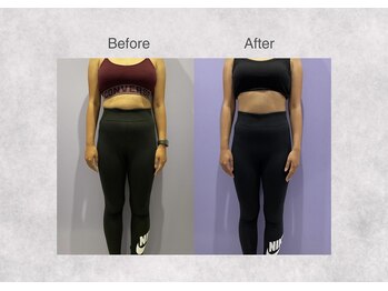 ミセル 尾道店(MYTHEL)/before after お腹