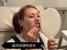 リオッサ オブ ラグーン(RIOSSA of Lagoon)/歯肉保護剤塗布　無味無臭！