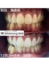ホワイトニングバー ファミリかしわ店/12回コース3回目のお客様