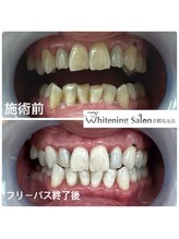 ホワイトニングサロン 京都烏丸店/ホワイトニング施術例