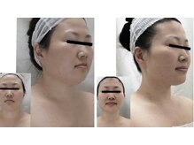 Nビューティー/最新RFサーモシェイプオーパス