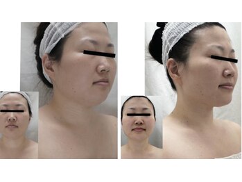 Nビューティー/最新RFサーモシェイプオーパス