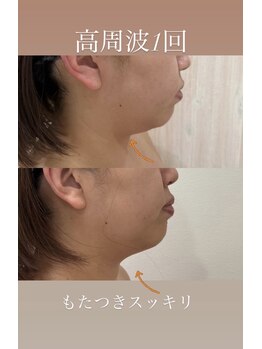 ダウンタイムオンニ(DowntimeOnni)/たるみケアもダウンタイムオンニ