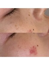 ビューティーサロン ココ(Coco～)/ハーブピーリング＋シミケア症例