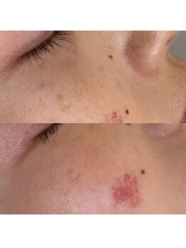 ビューティーサロン ココ(Coco~)/ハーブピーリング+シミケア症例