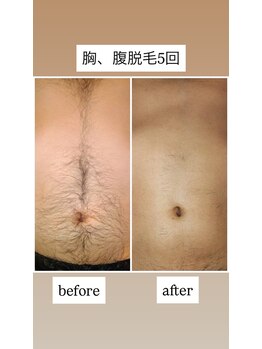 メンズナビ(men's nabi.)/胸、腹脱毛before→after