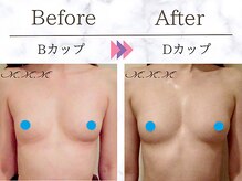 M.M.M 銀座本店/【バストアップ例】　B→Dカップ