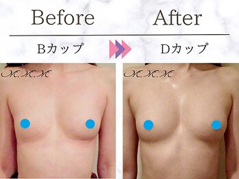 M.M.M 銀座本店/【バストアップ例】 B→Dカップ