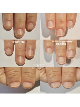 ニコプラス(NICO+)/自爪育成中