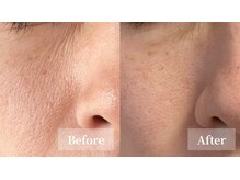 プレジール(plaisir)/毛穴ハイドロピーリング