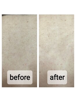 ナチュラル シャイン(NATURAL SHINE)/シュガーリング+光脱毛