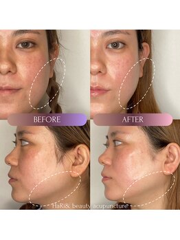 はりと美容鍼灸治療院(HaRi&美容鍼灸治療院)/