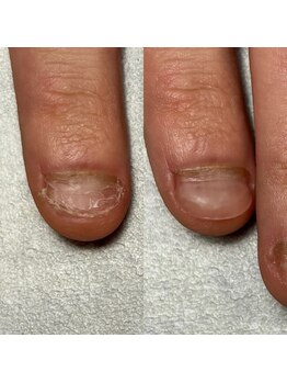 トレフル(Trefle)/メンズ深爪矯正