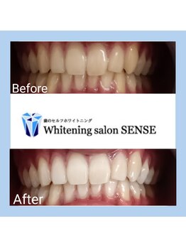センス(SENSE)/Before＆Aｆter　ホワイトニング