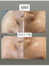 フットミー(foot mii)/角質ケア後はハイドロジュエリー