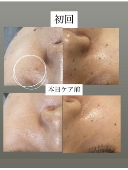 フットミー(foot mii)/角質ケア後はハイドロジュエリー