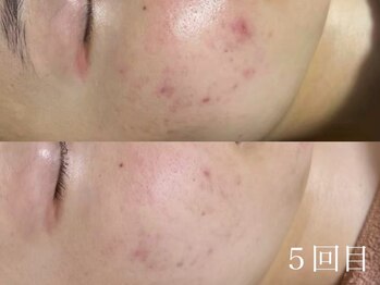 ホワイトアクア 京都店(WHITE AQUA)/ハーブピーリング/毛穴/京都