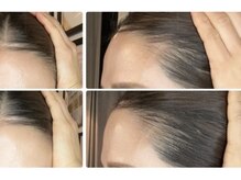 ルーナ 恵比寿(Luna)/ヘアロペーシア 女性症例