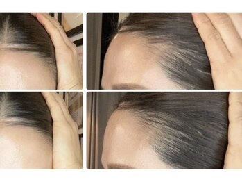 ルーナ 恵比寿(Luna)/ヘアロペーシア 女性症例