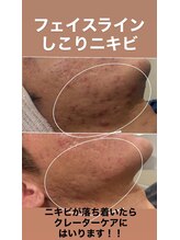 ハクビューティー(HAKU BEAUTY)/20代男性肌質改善