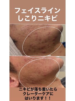 ハクビューティー(HAKU BEAUTY)/20代男性肌質改善
