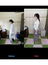 ミナト整骨院/猫背改善整体　Tさん1