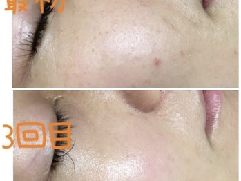 ニコ アンド キャンディー(Nico.&Candy)/毛穴洗浄＆光フェイシャル☆