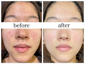 アリエス/肌質改善［毛穴/黒ずみ/ニキビ］