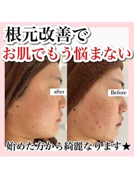 アルムダアクア 天王寺店(Aleumda AQUA)/ハーブピーリング/大阪/天王寺