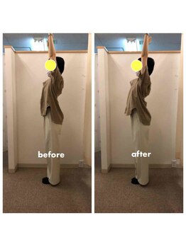 みらい整骨院/肩甲骨はがしで肩こり改善