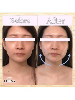 ウィズリリナ 新横浜(with Lilina.)/小顔蓄熱式超音波/1回/新横浜