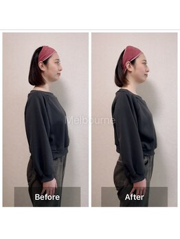 ラニ(Lani)/小顔美人整顔ビフォーアフター