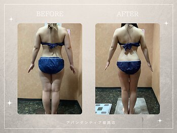 アバンダンティア 姫路店/脂肪冷却