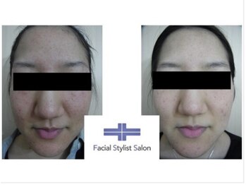 フェイシャルスタイリストサロン 四谷店/ケア例(42)