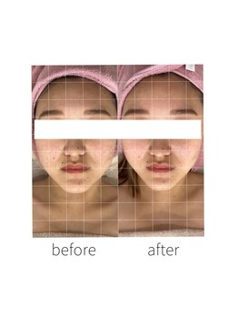 リリー(Lily)/ゼロコルギ