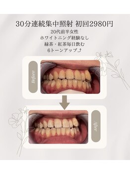プラスビーセルフ(+b self)/ホワイトニングビフォーアフター